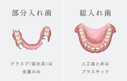部分入れ歯:クラスプ(留め具)は金属のみ/総入れ歯:人工歯と床はプラスチック