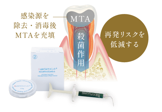 感染源を除去・消毒後MTAを充填して再発リスクを低減する