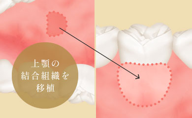 上顎の結合組織を移植